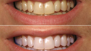Say Goodbye to Yellow Teeth with Tricity Smiles: A Guide to Teeth Whitening in Chandigarh