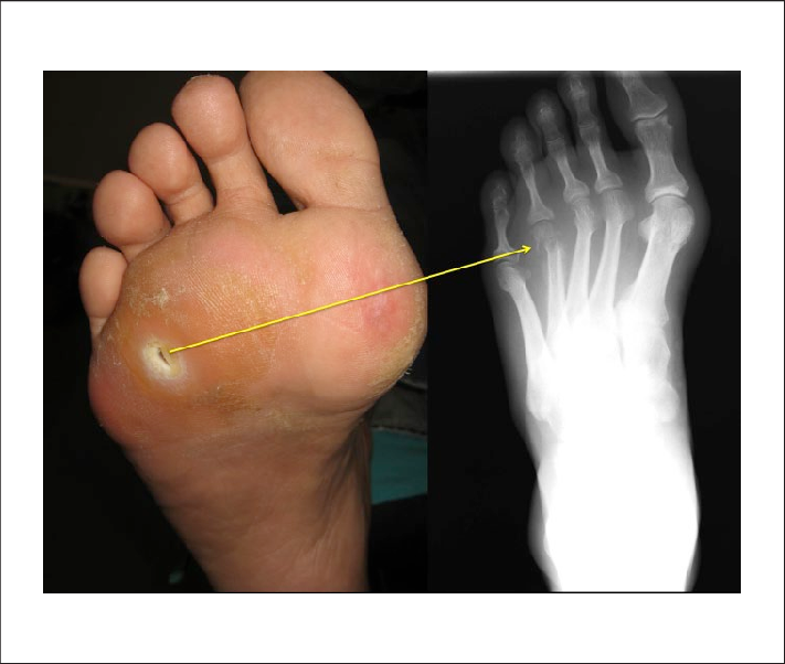 Osteomyelitis