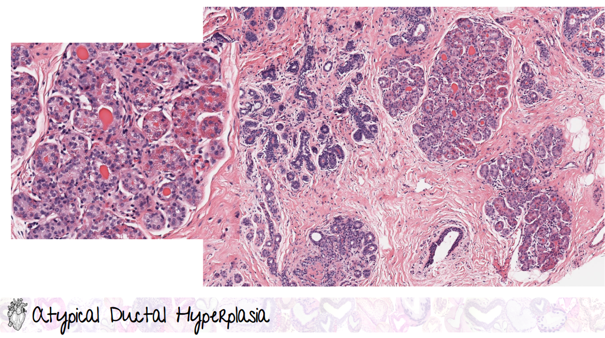 High Yield Breast Pathology Atypical Ductal Hyperplasia (ADH)
