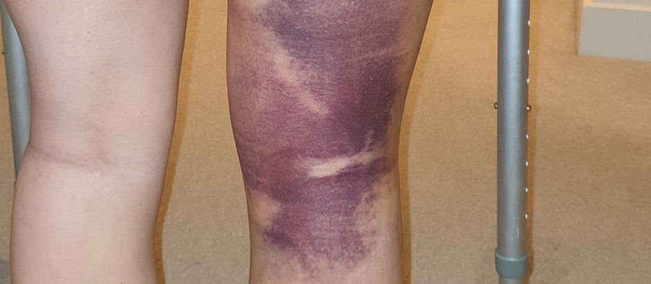 Beckys Rehab: The first 2 weeks!