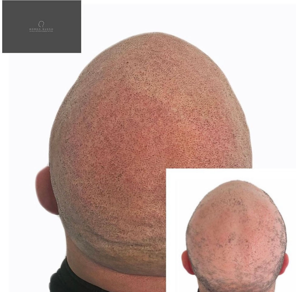 Alopecia