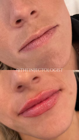 Before and after picture of a client who received lip filler