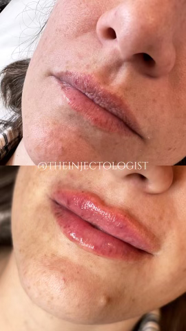 Before and after picture of a client who received lip filler