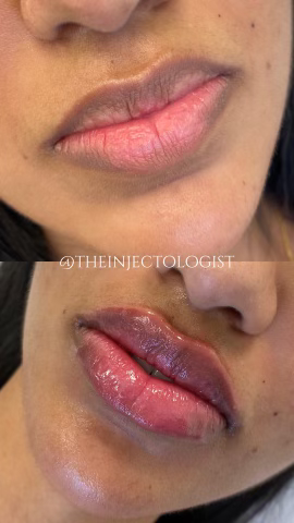 Before and after picture of a client who received lip filler
