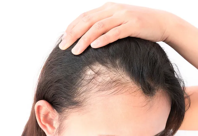 Haarausfall Typen Haarsysteme Laterra Altdorf Bei Nurnberg