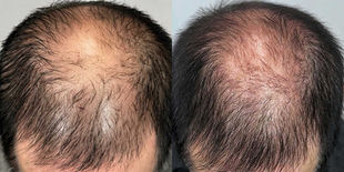 1 AnteAGE Hair Microneedling Treatment + Home Hair System

8 Weeks