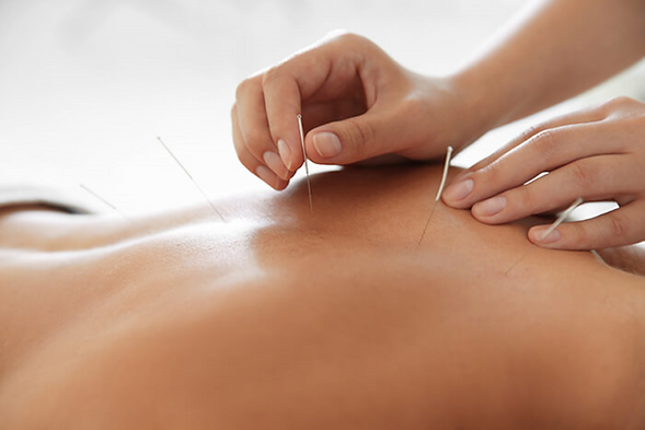 Acupuncture treatment in progress for back pain relief.