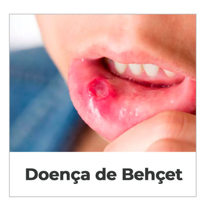 Doença de Behçet.jpg