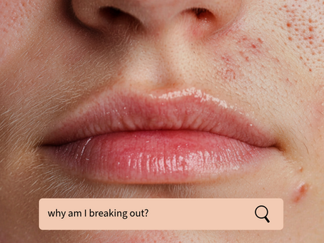 Understanding Your Acne: A Skin Chic Guide