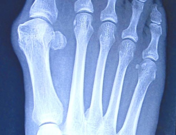 An x-ray image of a right foot bunion