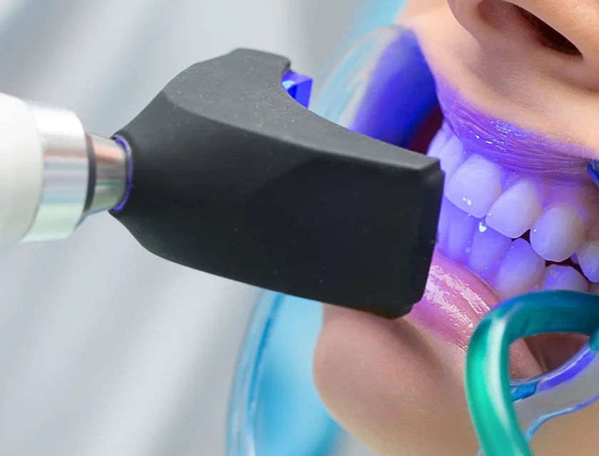 Tooth filling ultraviolet lamp_edited_jp.webp
