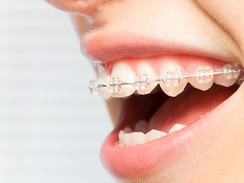 Orthodontics correction of jaws with clear bracket_edited (1).jpg