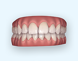 iTeroElement2_frontviewtop_soutcomesim_whiteBKG.png