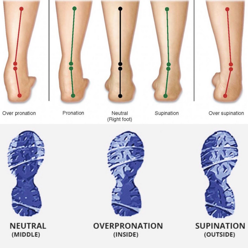 Helping Overpronation Why Shoe Stability is the Key