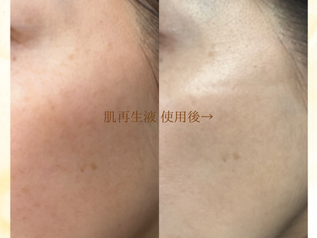 **シミ改善フェイシャルエステ**変化**