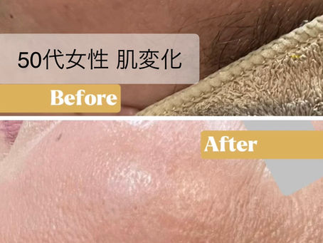 【50代・目元の大きなシミに変化】
