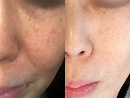 ファンデーションで隠し続ける毎日から卒業しませんか？