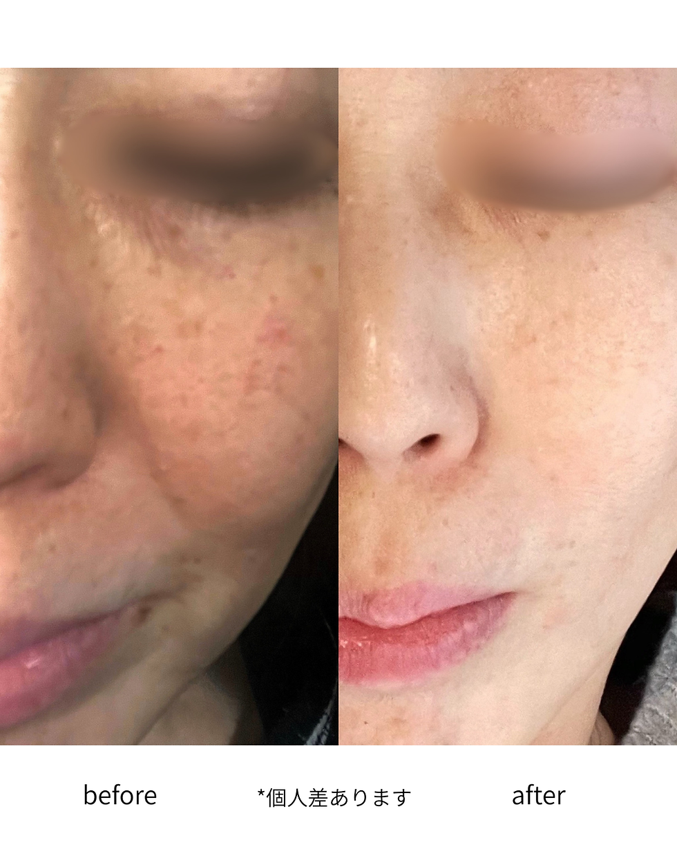 ファンデーションで隠し続ける毎日から卒業しませんか？