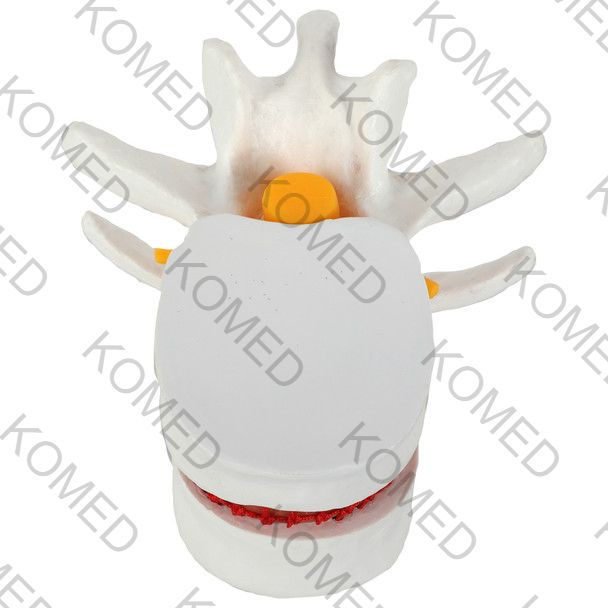 Thumbnail: Human Lumbar Herniating Disc Demonstration Anatomy Model