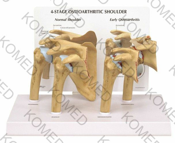 4-Stage Osteoarthritis Shoulder Anatomy Model