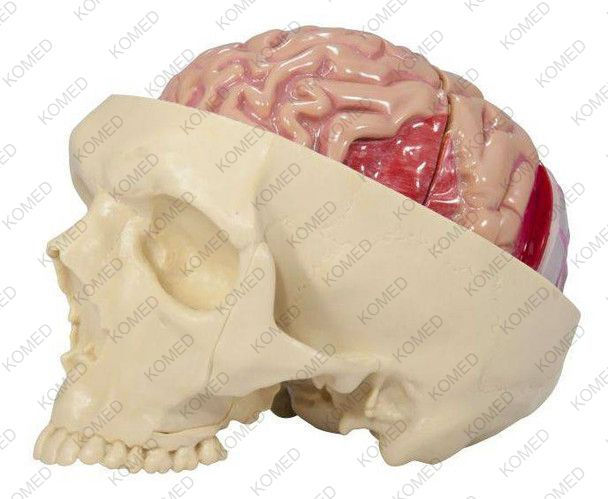 Thumbnail: Diseased Brain In Skull Anatomy Model