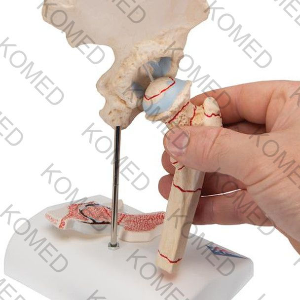 Thumbnail: Femoral Fracture Anatomy Model