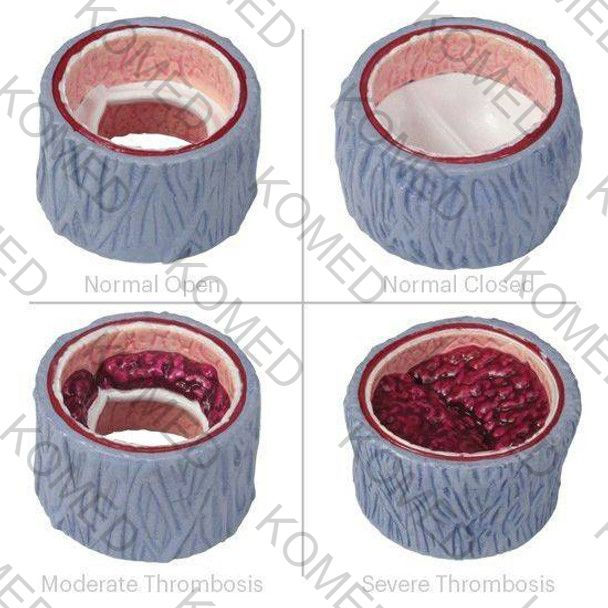 4-Piece Vein Cross Section Anatomy Model