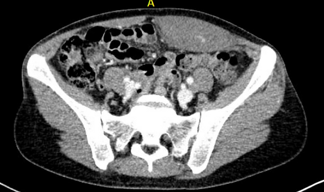 Rectus Sheath Hematoma CT Scan