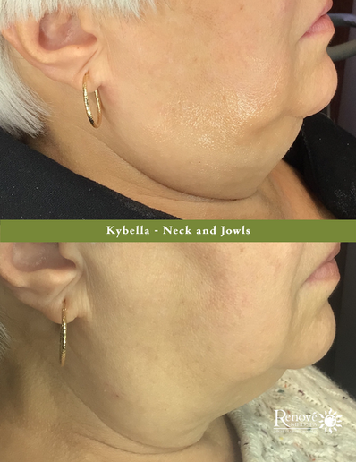 RMS-Kybella-Neck&Jowls-Office.png