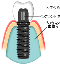 油谷歯科医院インプラント治療イラスト
