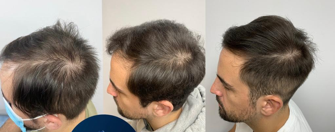 Recupera tu cabello