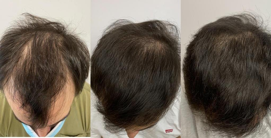 Recupera tu cabello