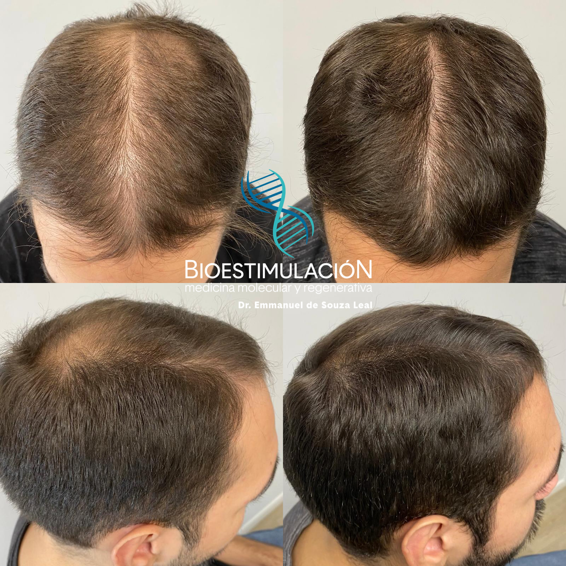 Alopecia Masculina