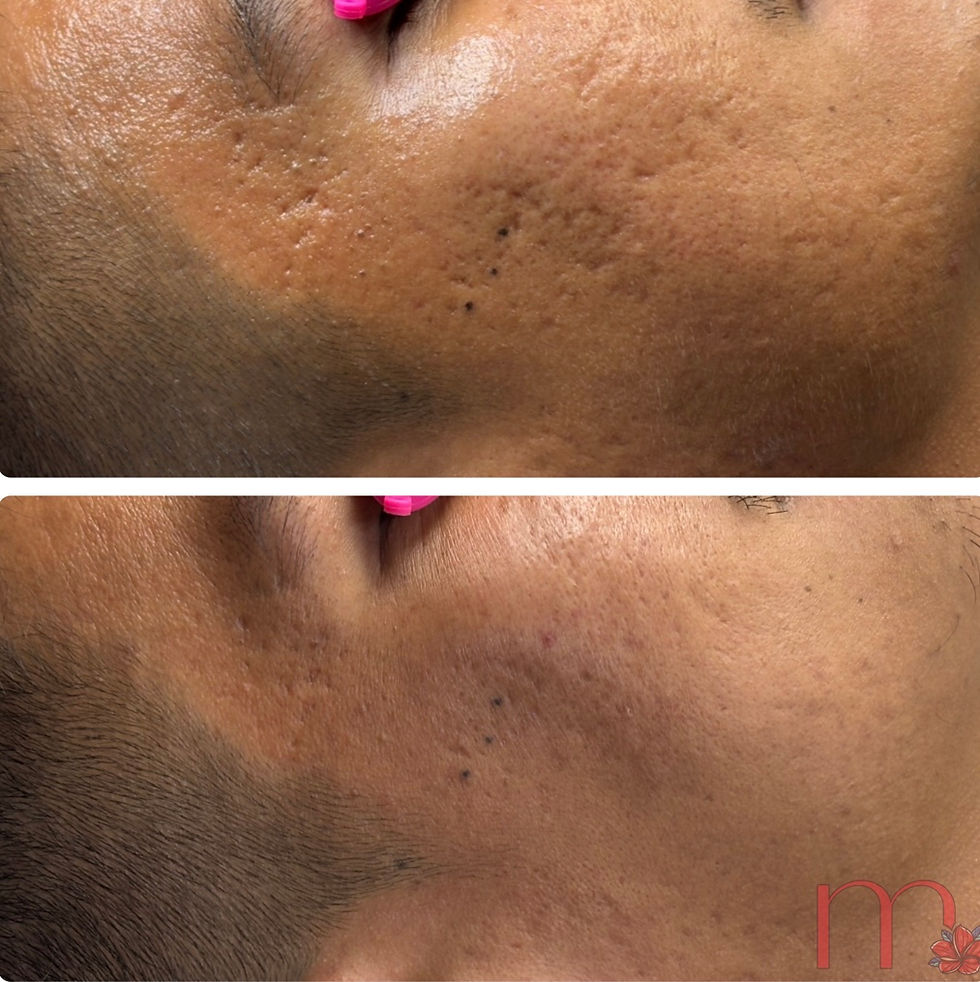 before-after-microneedling-acne-scars-atlanta