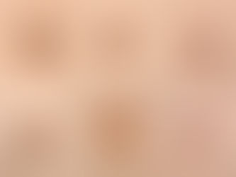 Close-up examples of different types of benign moles on skin