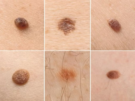 Close-up examples of different types of benign moles on skin