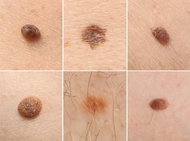 Close-up examples of different types of benign moles on skin