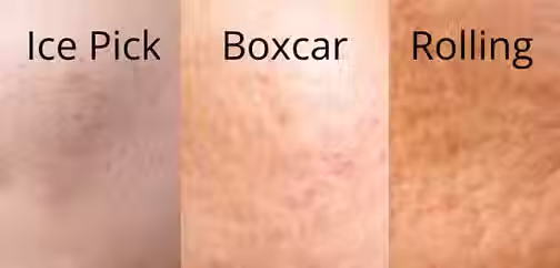 acne scar types ice pick boxcar rolling