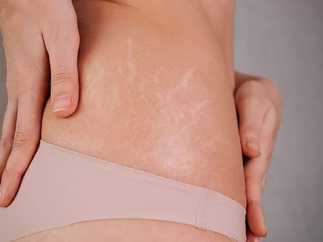 Microneedling treatment for stretch marks on abdomen in Atlanta