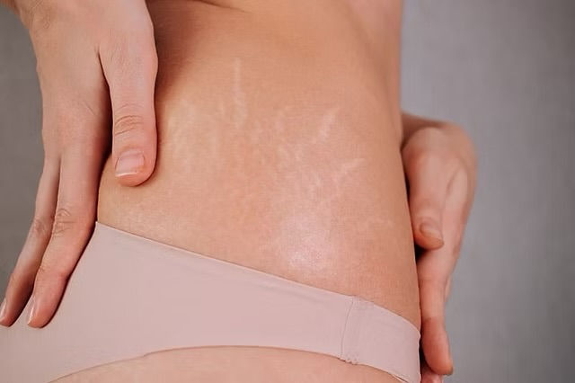 Microneedling treatment for stretch marks on abdomen in Atlanta
