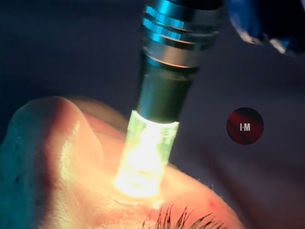 professional infrared microneedling device used by estheticians for advanced skin rejuvenation treatments