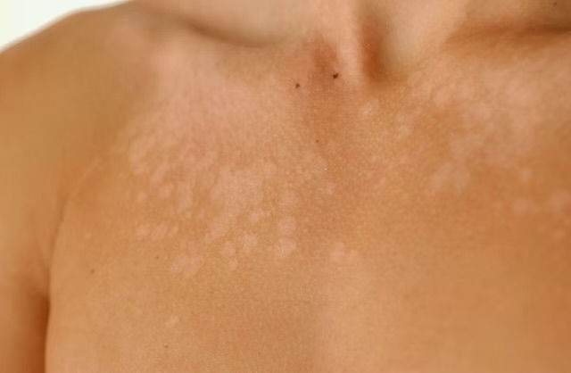 Hypopigmentation on chest before microneedling treatment in Atlanta.