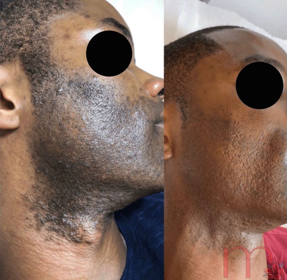 Man receiving microneedling treatment for beard hyperpigmentation and dark spots in Atlanta.