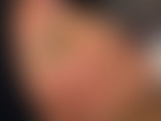 Client immediately after microneedling treatment showing normal redness during recovery in Atlanta
