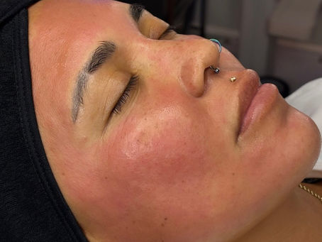 Client immediately after microneedling treatment showing normal redness during recovery in Atlanta