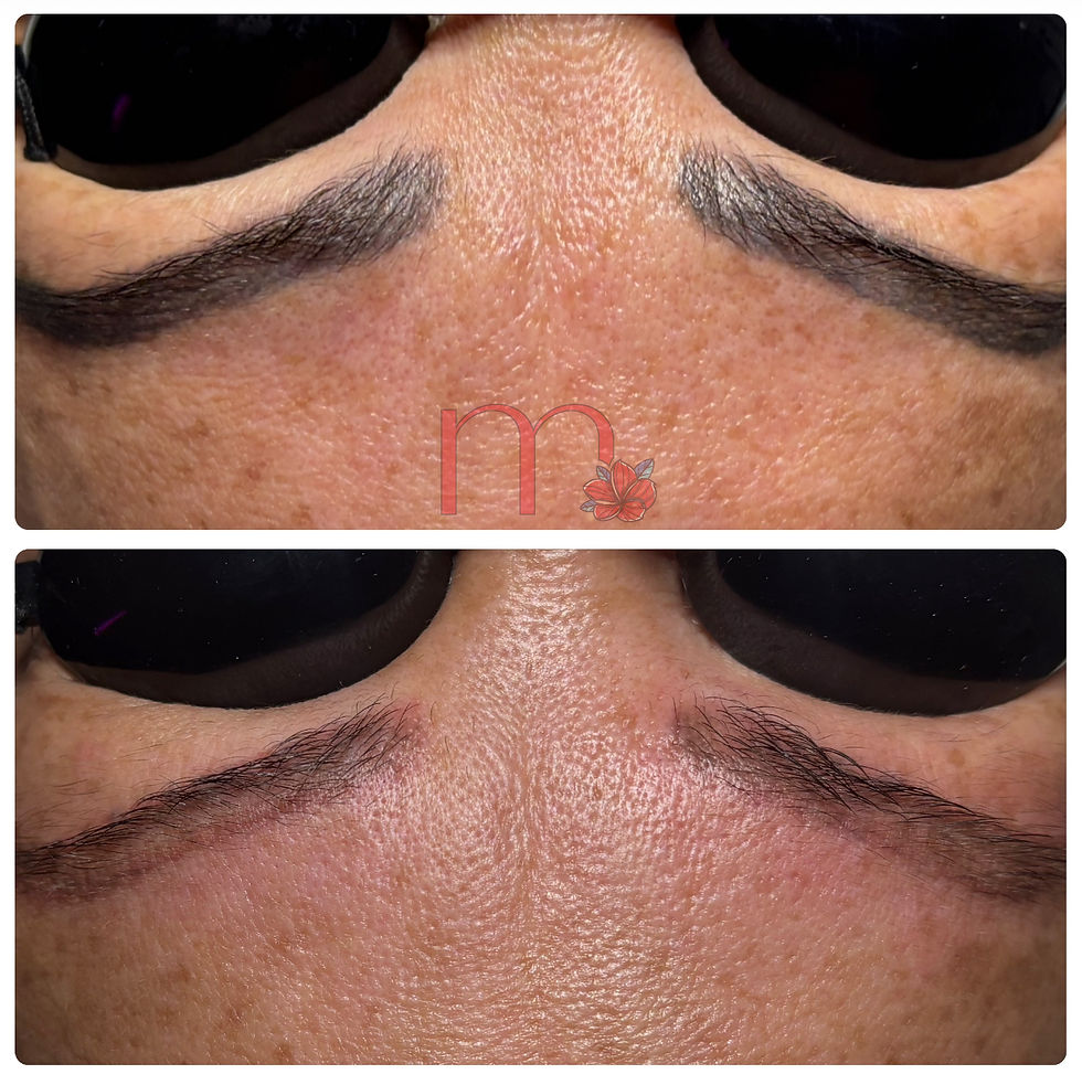 Laser eyebrow tattoo removal before and after results for microblading removal at The Mbar Medspa Atlanta.