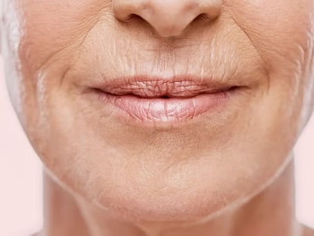 Woman with visible fine lines around mouth before microneedling wrinkle treatment in Atlanta.