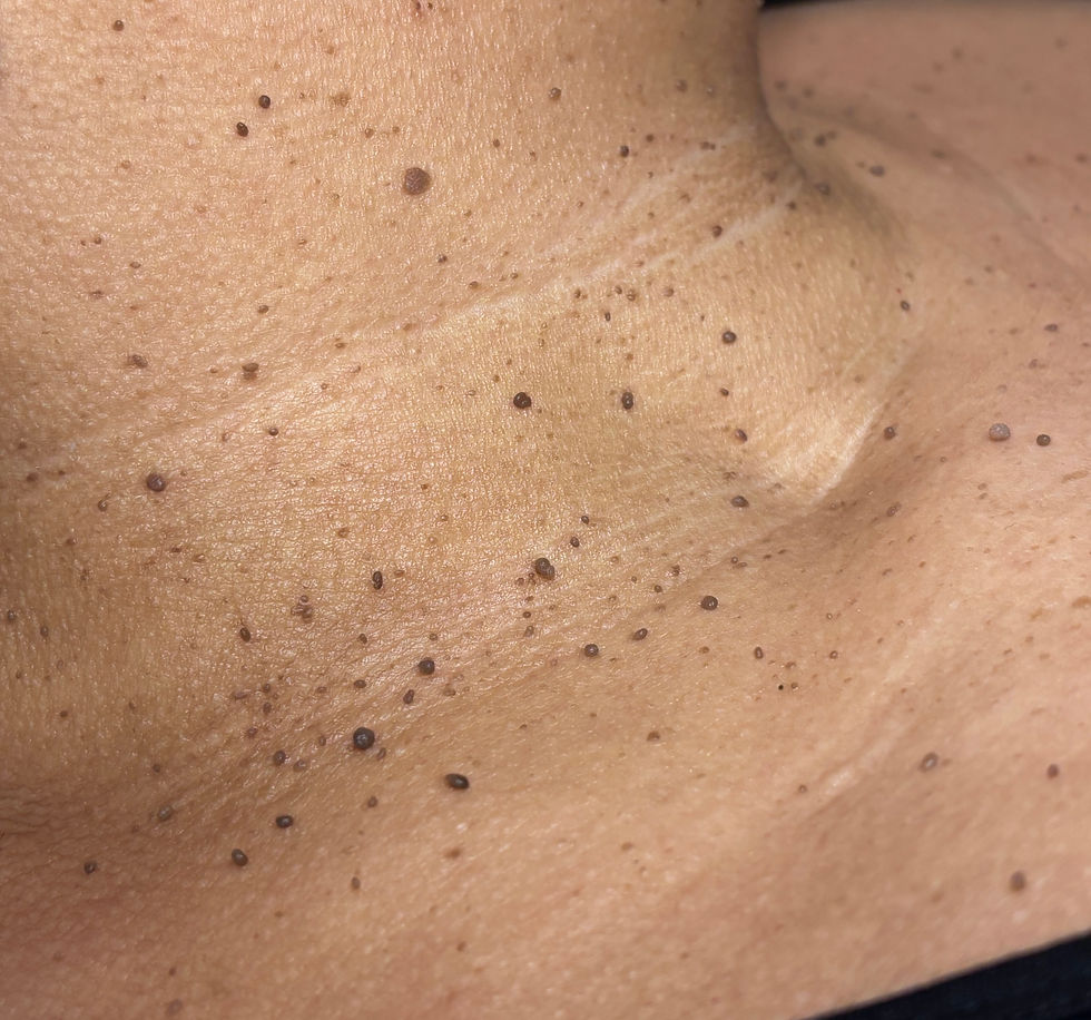 Woman with multiple skin tags on the neck associated with PCOS before professional skin tag removal treatment in Atlanta, Georgia.
