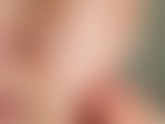 Close-up of enlarged facial pores demonstrating uneven skin texture before professional microneedling treatment at The Mbar Medspa in Atlanta.