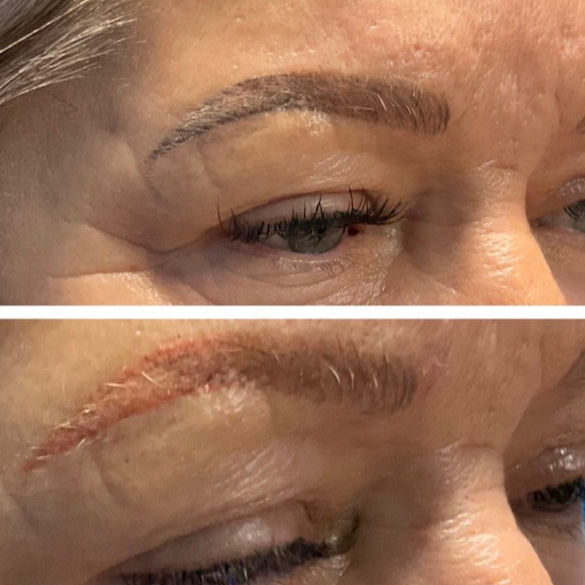 Before and after of brow removal process Atlanta